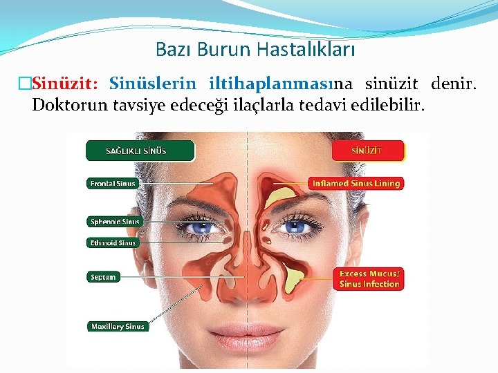 Bazı Burun Hastalıkları �Sinüzit: Sinüslerin iltihaplanmasına sinüzit denir. Doktorun tavsiye edeceği ilaçlarla tedavi edilebilir.