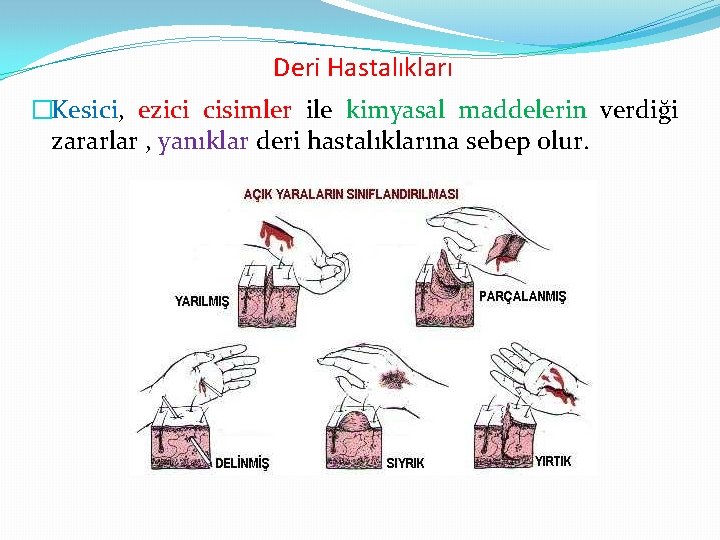 Deri Hastalıkları �Kesici, ezici cisimler ile kimyasal maddelerin verdiği zararlar , yanıklar deri hastalıklarına