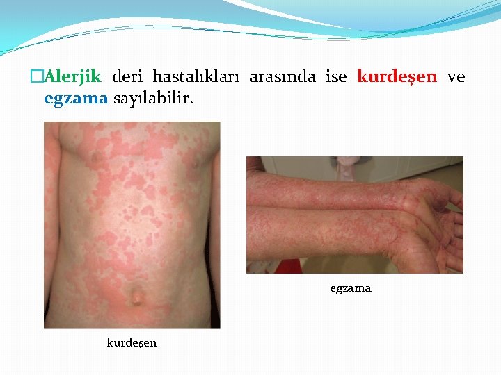 �Alerjik deri hastalıkları arasında ise kurdeşen ve egzama sayılabilir. egzama kurdeşen 