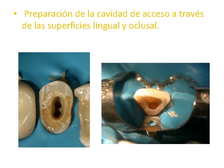  • Preparación de la cavidad de acceso a través de las superficies lingual