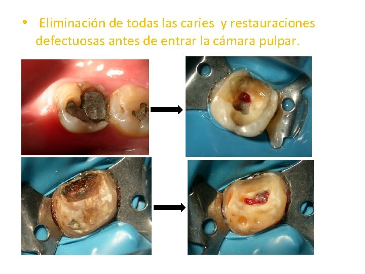  • Eliminación de todas las caries y restauraciones defectuosas antes de entrar la