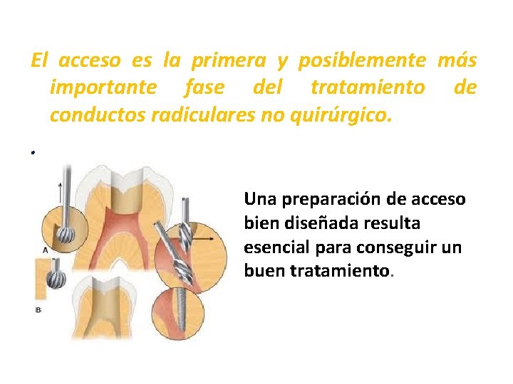 El acceso es la primera y posiblemente más importante fase del tratamiento de conductos