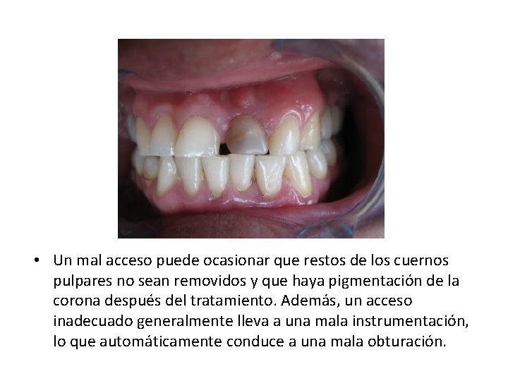  • Un mal acceso puede ocasionar que restos de los cuernos pulpares no