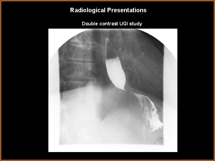 Radiological Presentations Double contrast UGI study 