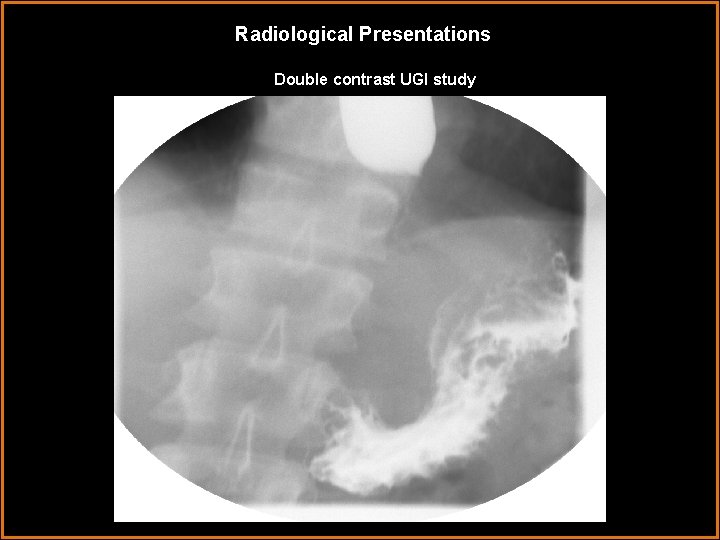 Radiological Presentations Double contrast UGI study 