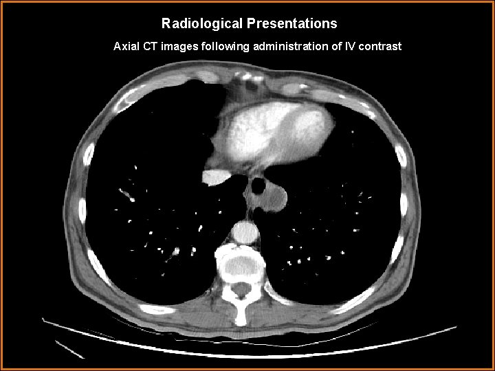 Radiological Presentations Axial CT images following administration of IV contrast 