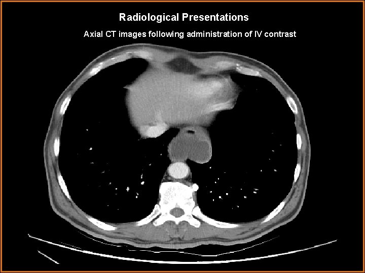 Radiological Presentations Axial CT images following administration of IV contrast 
