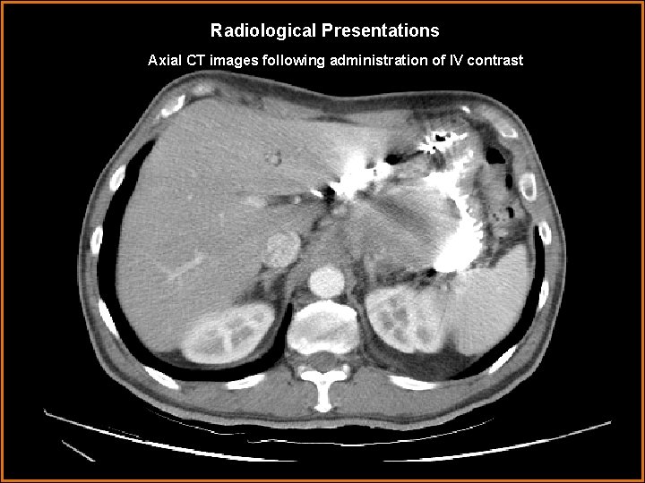 Radiological Presentations Axial CT images following administration of IV contrast 