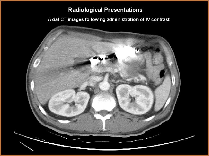 Radiological Presentations Axial CT images following administration of IV contrast 