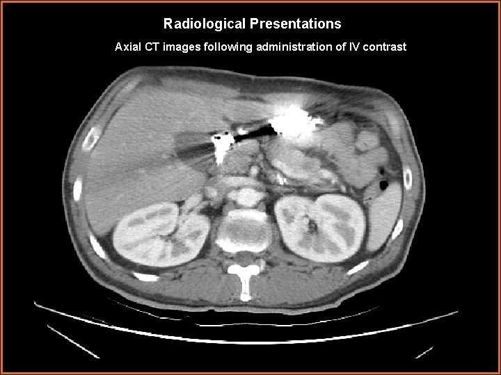 Radiological Presentations Axial CT images following administration of IV contrast 