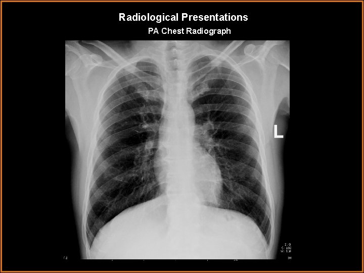 Radiological Presentations PA Chest Radiograph 