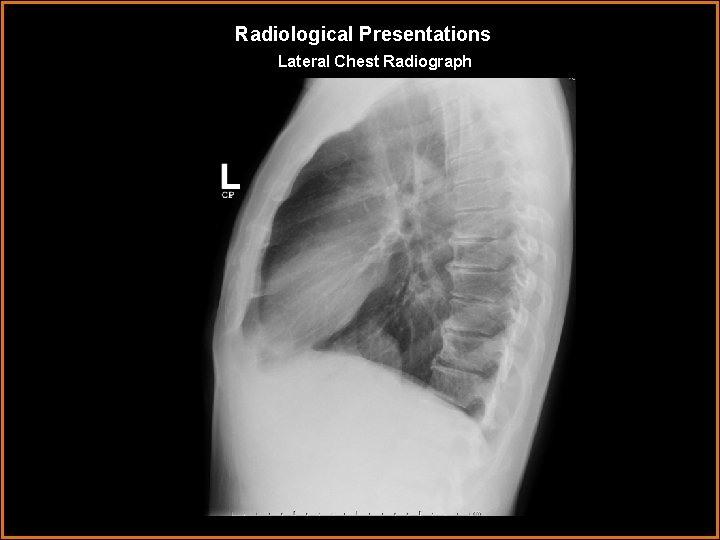 Radiological Presentations Lateral Chest Radiograph 