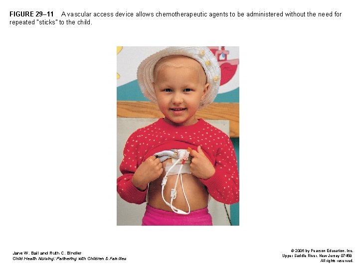 FIGURE 29– 11 A vascular access device allows chemotherapeutic agents to be administered without FIGURE 29– 11 A vascular access device allows chemotherapeutic agents to be administered without