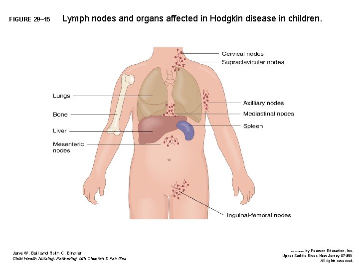 FIGURE 29– 15 Lymph nodes and organs affected in Hodgkin disease in children. Jane FIGURE 29– 15 Lymph nodes and organs affected in Hodgkin disease in children. Jane