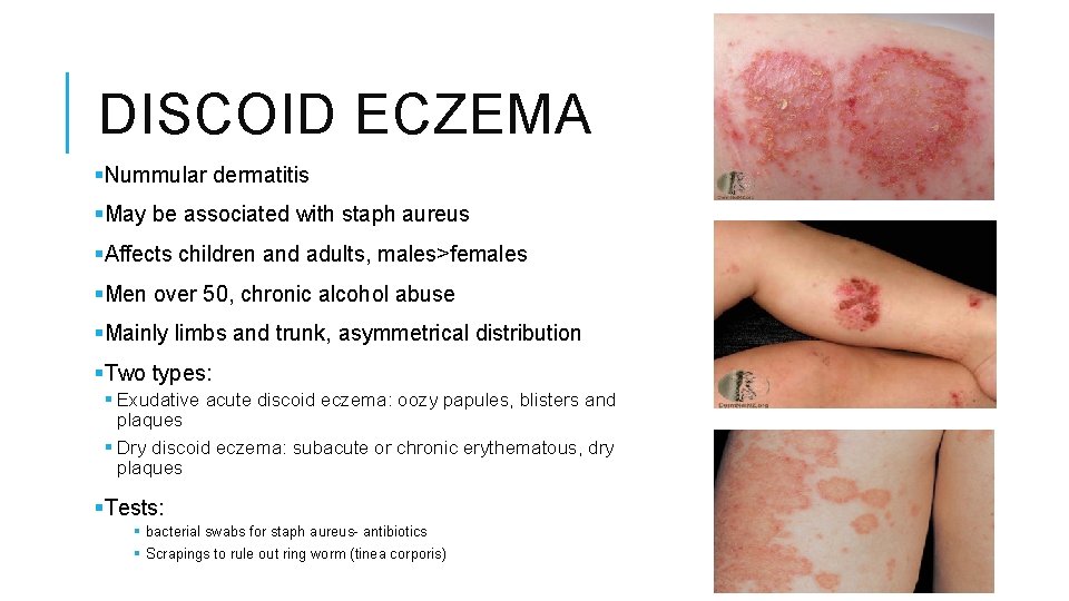 Eczema Learning Objectives Recognise The Features Of An