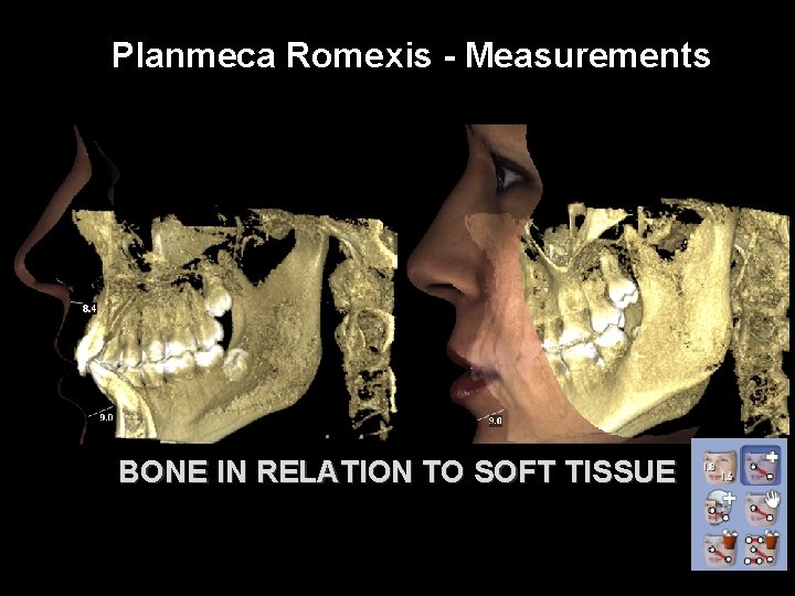 Planmeca Romexis - Measurements BONE IN RELATION TO SOFT TISSUE 