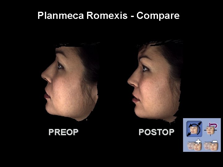 Planmeca Romexis - Compare PREOP POSTOP 
