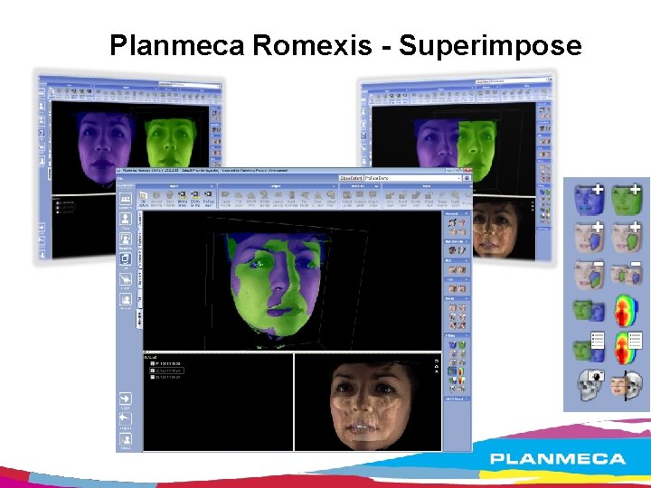 Planmeca Romexis - Superimpose 