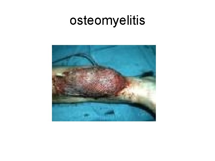 osteomyelitis 