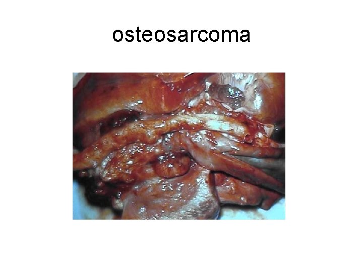 osteosarcoma 