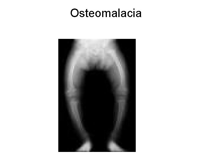 Osteomalacia 