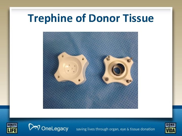 Trephine of Donor Tissue 