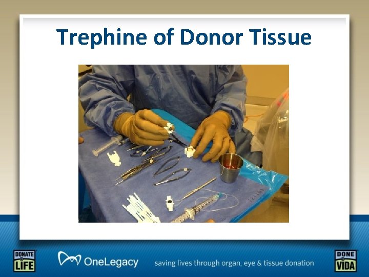Trephine of Donor Tissue 