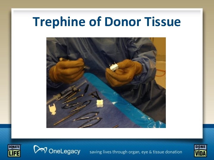 Trephine of Donor Tissue 