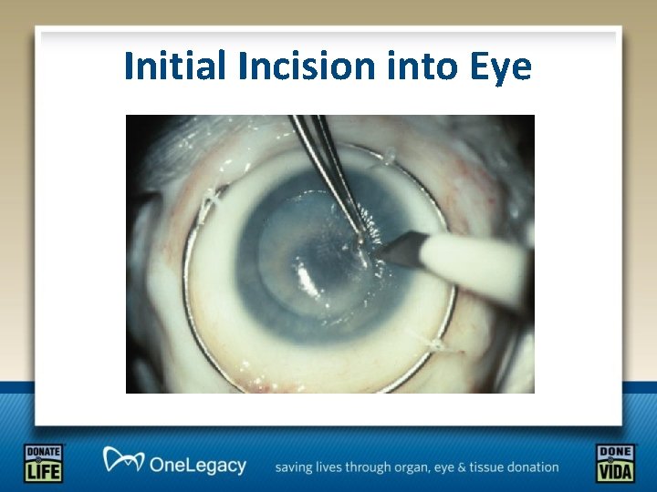 Initial Incision into Eye 
