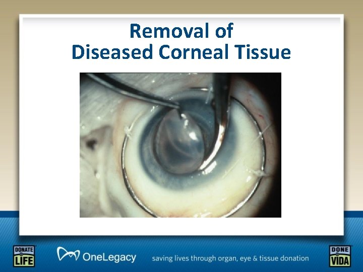 Removal of Diseased Corneal Tissue 