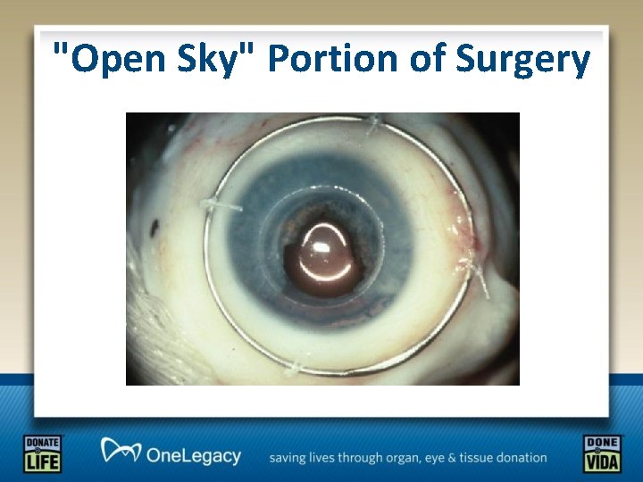 "Open Sky" Portion of Surgery 