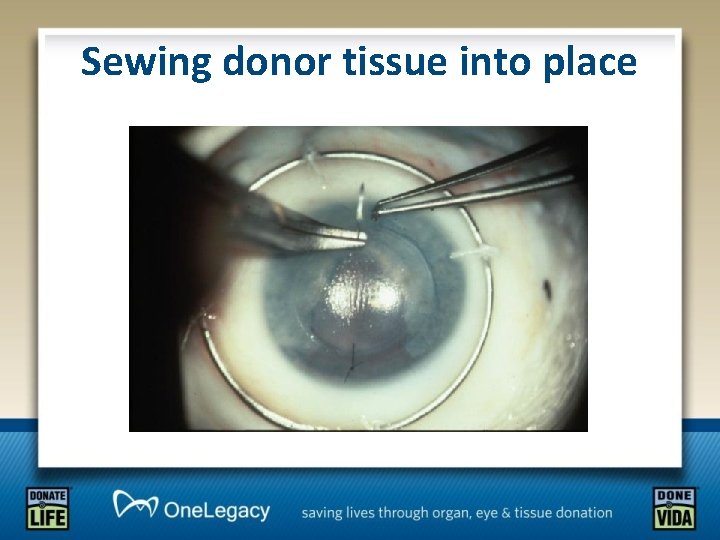 Sewing donor tissue into place 
