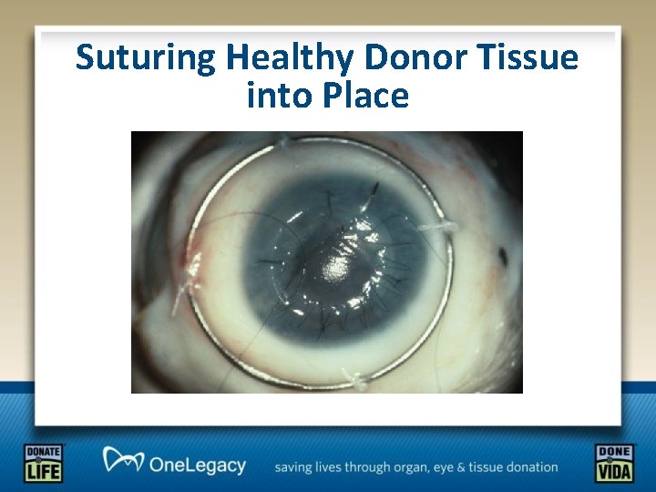 Suturing Healthy Donor Tissue into Place 