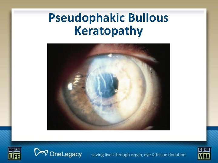 Pseudophakic Bullous Keratopathy 