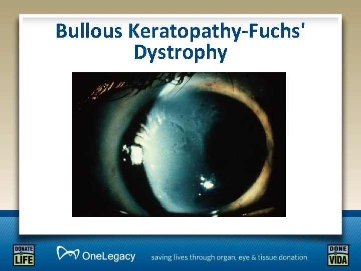 Bullous Keratopathy-Fuchs' Dystrophy 
