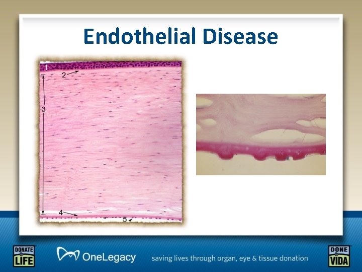 Endothelial Disease 