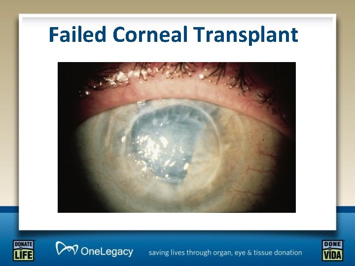 Failed Corneal Transplant 