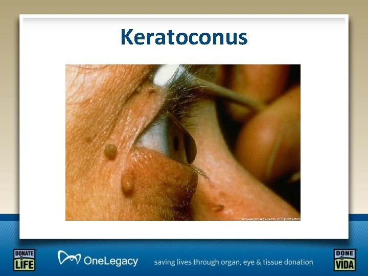 Keratoconus 