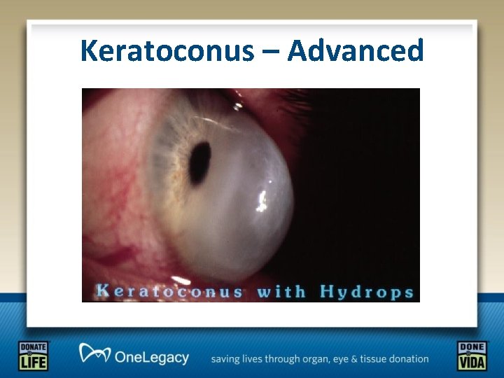 Keratoconus – Advanced 
