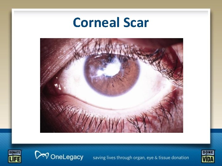 Corneal Scar 
