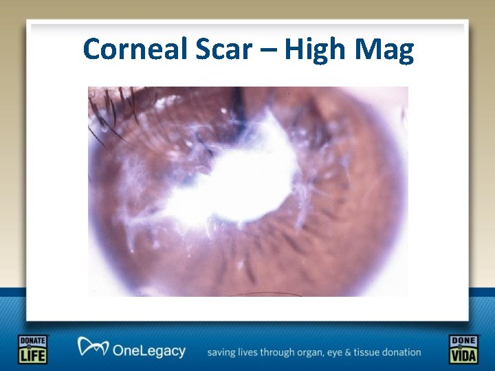 Corneal Scar – High Mag 