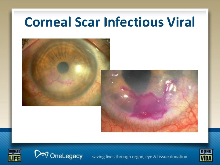 Corneal Scar Infectious Viral 