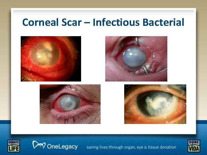 Corneal Scar – Infectious Bacterial 