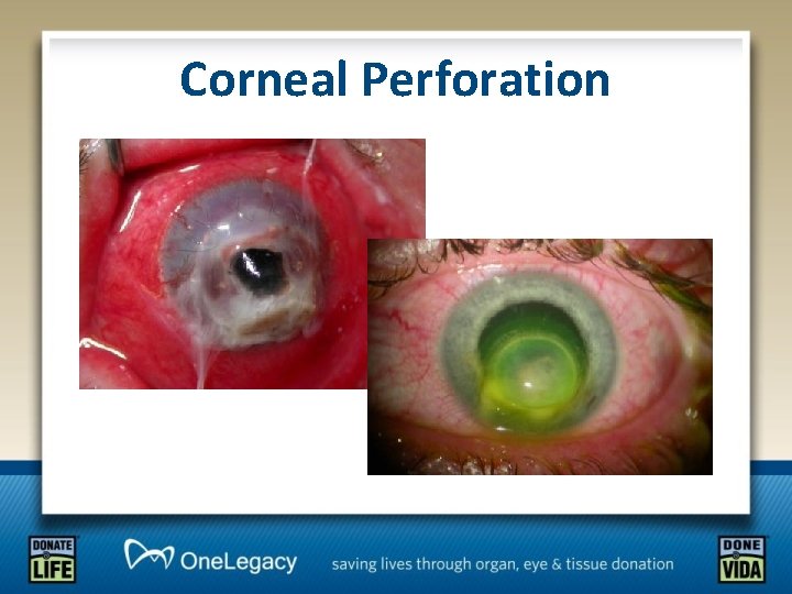 Corneal Perforation 
