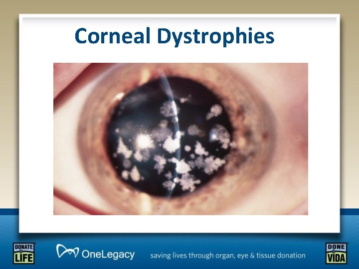 Corneal Dystrophies 