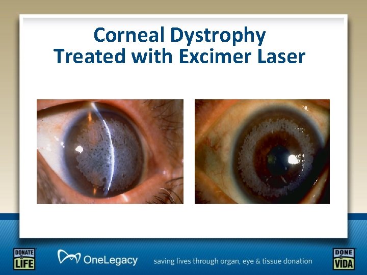 Corneal Dystrophy Treated with Excimer Laser 