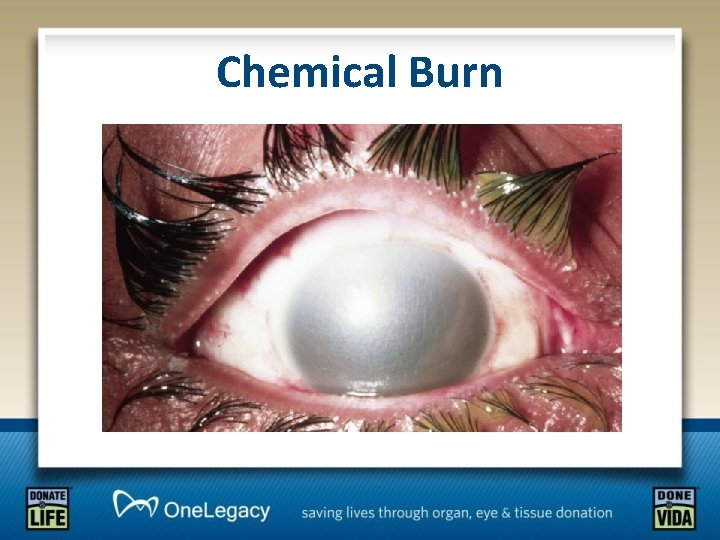Chemical Burn 