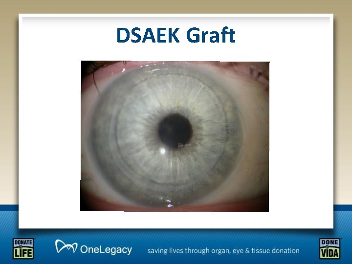 DSAEK Graft 