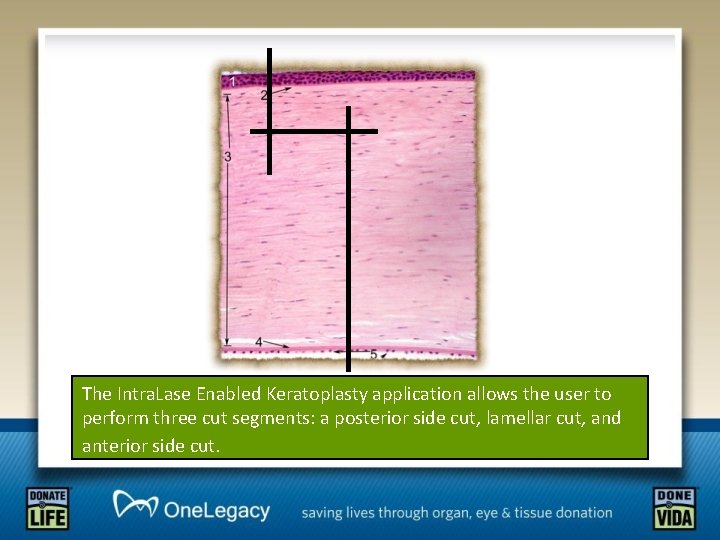 The Intra. Lase Enabled Keratoplasty application allows the user to perform three cut segments: