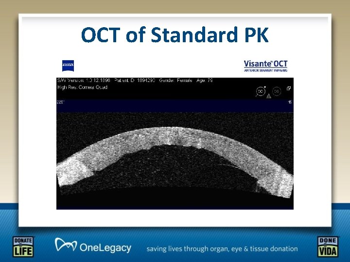 OCT of Standard PK 